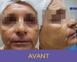 mesofils 2| Médecine esthétique à La Réunion